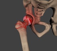 Core Decompression for Avascular Necrosis of the Hip 