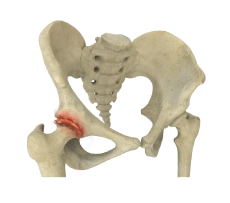 Hip Arthritis