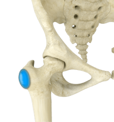 Hip Bursitis