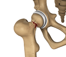 Hip Injuries