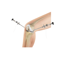 Knee Arthroscopy