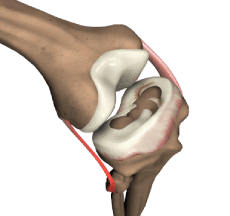 Meniscus Repair