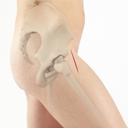 Minimally Invasive Hip Replacement - Direct Anterior Approach