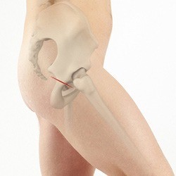 Minimally Invasive Hip Replacement - Direct Superior Approach