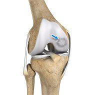 Osteochondritis Dissecans