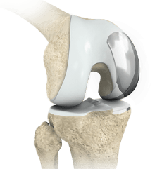 Partial Knee Replacement