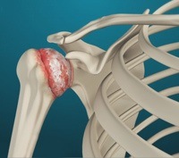 Shoulder Arthritis