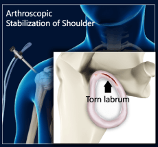 Shoulder Stabilization