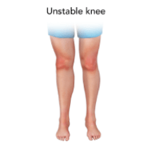 Unstable Knee